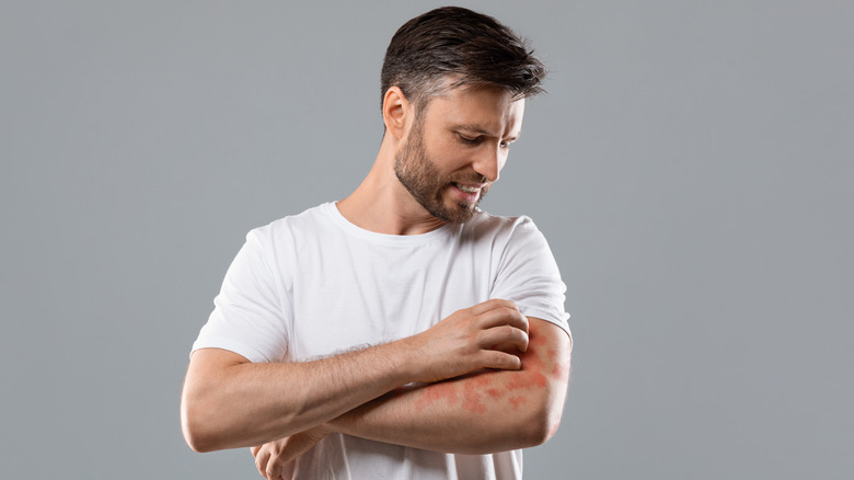 Man in a white t-shirt scratching his arm, which has red marks on it