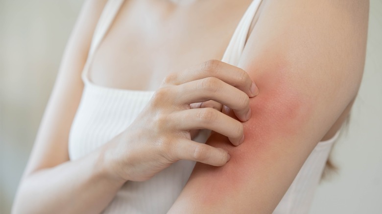 Young Woman Scratching Itchy, Dry Skin
