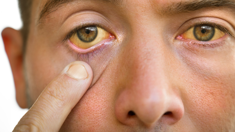 Close up of a man with jaundice pulling down the lower lid of his right eye