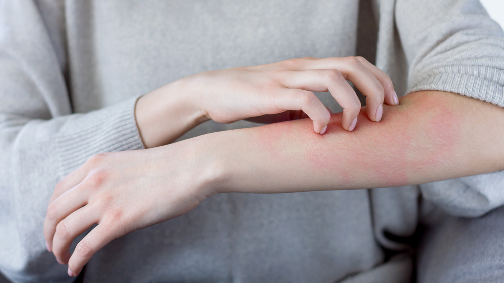 Itchy rash from spending too much time inside